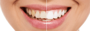 How Redlands Gentle Dental can whiten your teeth