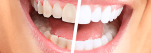 What is Zoom! teeth whitening