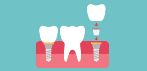 What are my options to replace missing teeth? | Redlands Gentle Dental Care